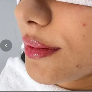 آموزش فیلر بوتاکس توسط پزشک