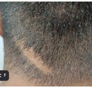 آموزش متدمیکرواسکالپ