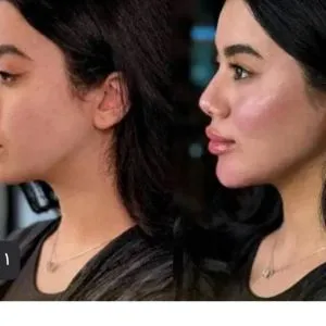 آموزش ترزیق فیلروبوتاکس