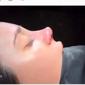 پزشک و جراح پلاستیک ،عمل بینی