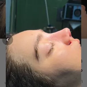 عمل بینی درشهرکرد