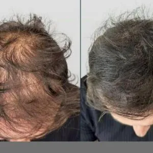 اسکالپ تخصصی در کلینیک پوست و مو