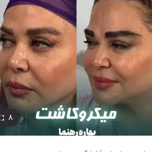 کلینیک کاشت مووابرو