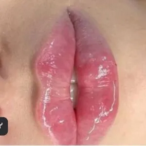 کلینیگ زیبایی وترزیق ژل لب